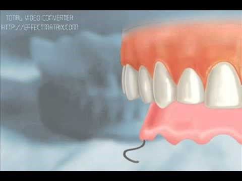 Ultimate Fit Dentures Forestville MI 48434